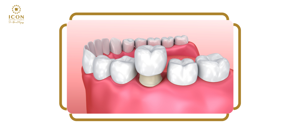 تركيب اسنان