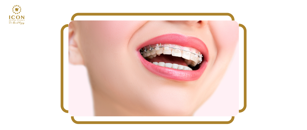 تقويم الاسنان